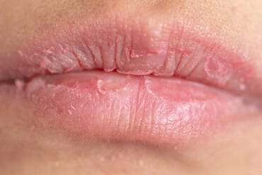 chapped lips in pregnancy