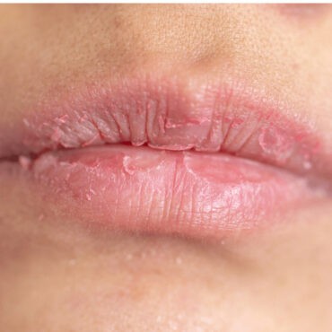 chapped lips in pregnancy