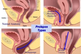 prolapse after giving birth