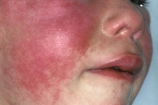 slapped cheek or scarlet fever