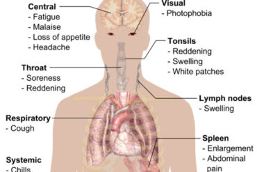 symptoms of glandular fever